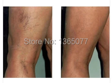 Бесплатная доставка Супер алоэ витамин K эму сыворотка целлюлитный паук Vericose