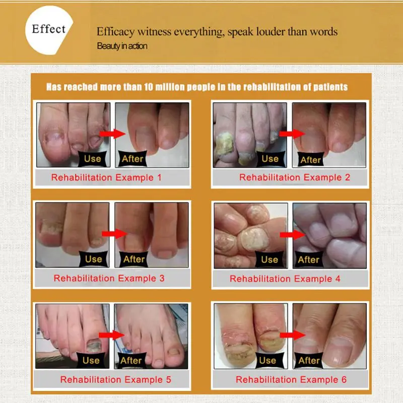 Горячая 30 мл гель для ухода за ногтями грибковое Лечение ногтей эссенция