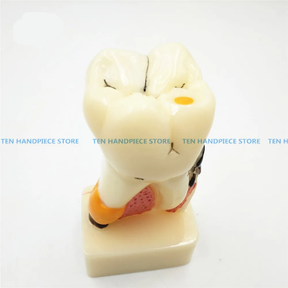 

2018 good quality Dental implant Demonstration Bracket Simulation Teeth Model teeth removable