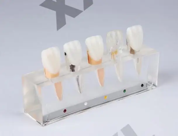 pathology Patient communication model Endodontic treatment Upper central incisor free shipping