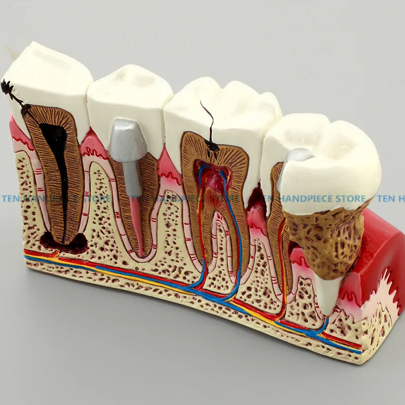 

2018 good quality Caries Tooth Model Dentist Patient Communication Anatomy Model Dentistry Rich Details Teaching Aids Equipment