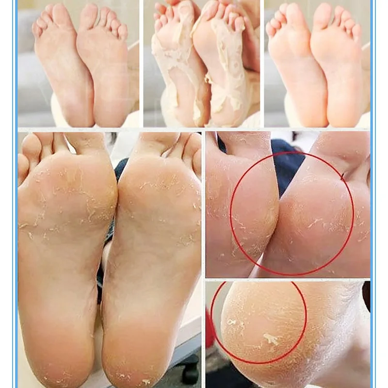 10 пар = 20 шт. отшелушивающая маска для ног увлажняющие носочки педикюра пилинг