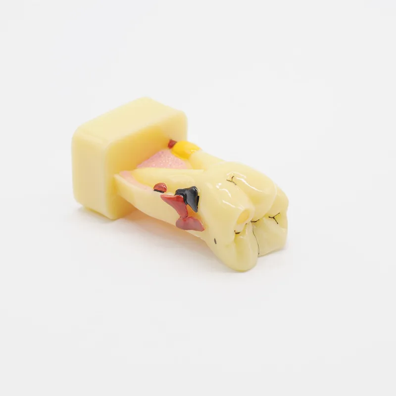 

Study Teach Tooth Model Teeth Disease Model For Dental Lab Equipment