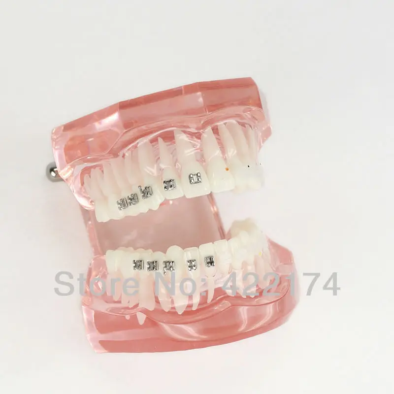 Бесплатная доставка полуметаллическая металлическая модель ортодонтики