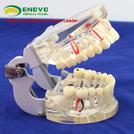 

Transparent adult comprehensive oral pathology model dental model periodontal disease dental caries demonstration model