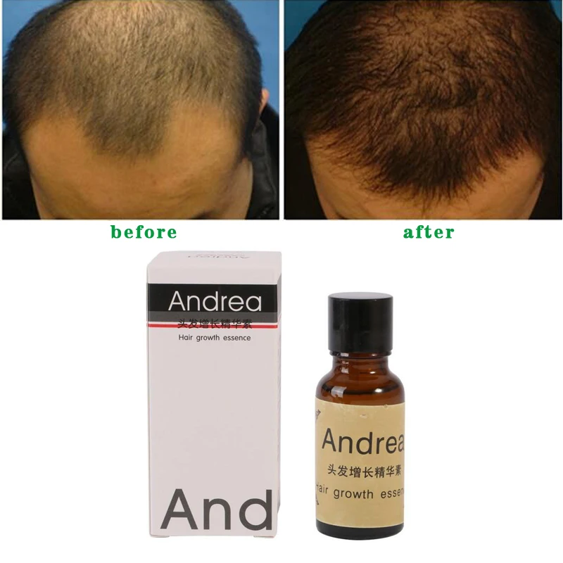

Andrea роста волос против выпадения волос лечения Для мужчин t Предотвращение более выпадения волос Масло жидкое средства по уходу за волосами...