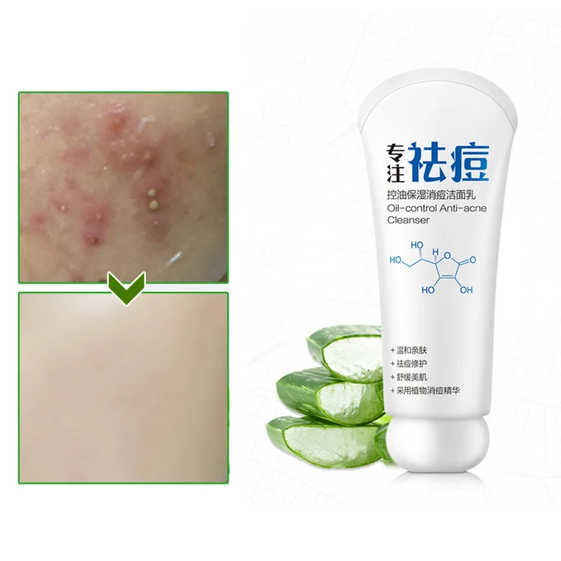 Новое очищающее средство для лица 80 г лечения акне удаления черных точек с