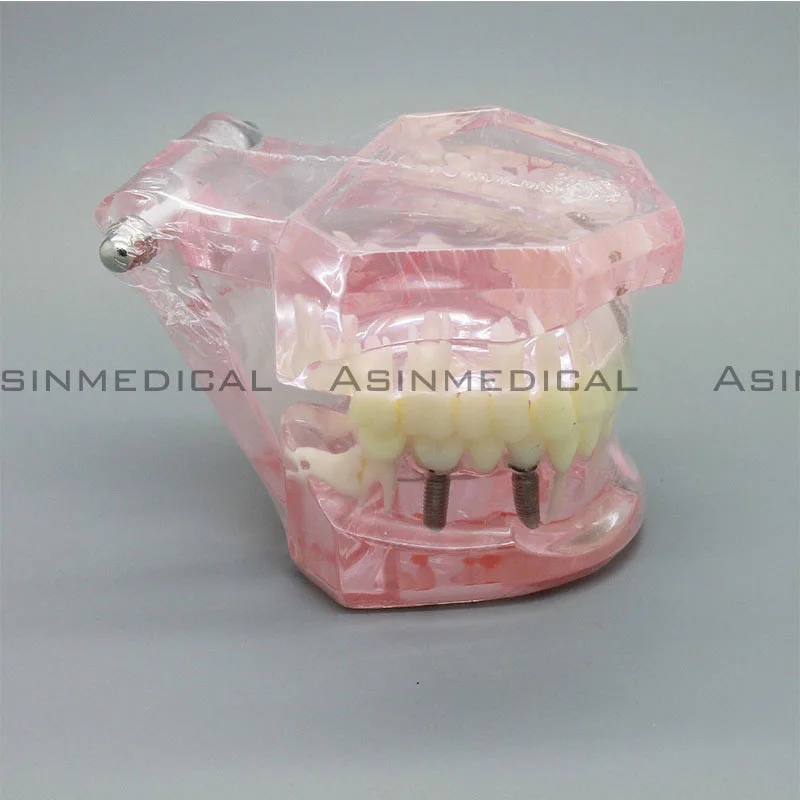 

NEW Arrival high quality Dental implant Demonstration Bracket Simulation Teeth Model teeth removable