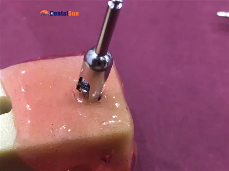 

New Arrival CE/ISO Approved Dental Implant Neat Tissue Former Kit
