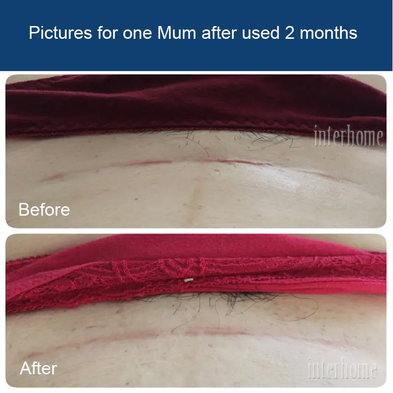 Новинка 2018 эффективная хирургия цезареза силиконовый Гель для удаления шрамов