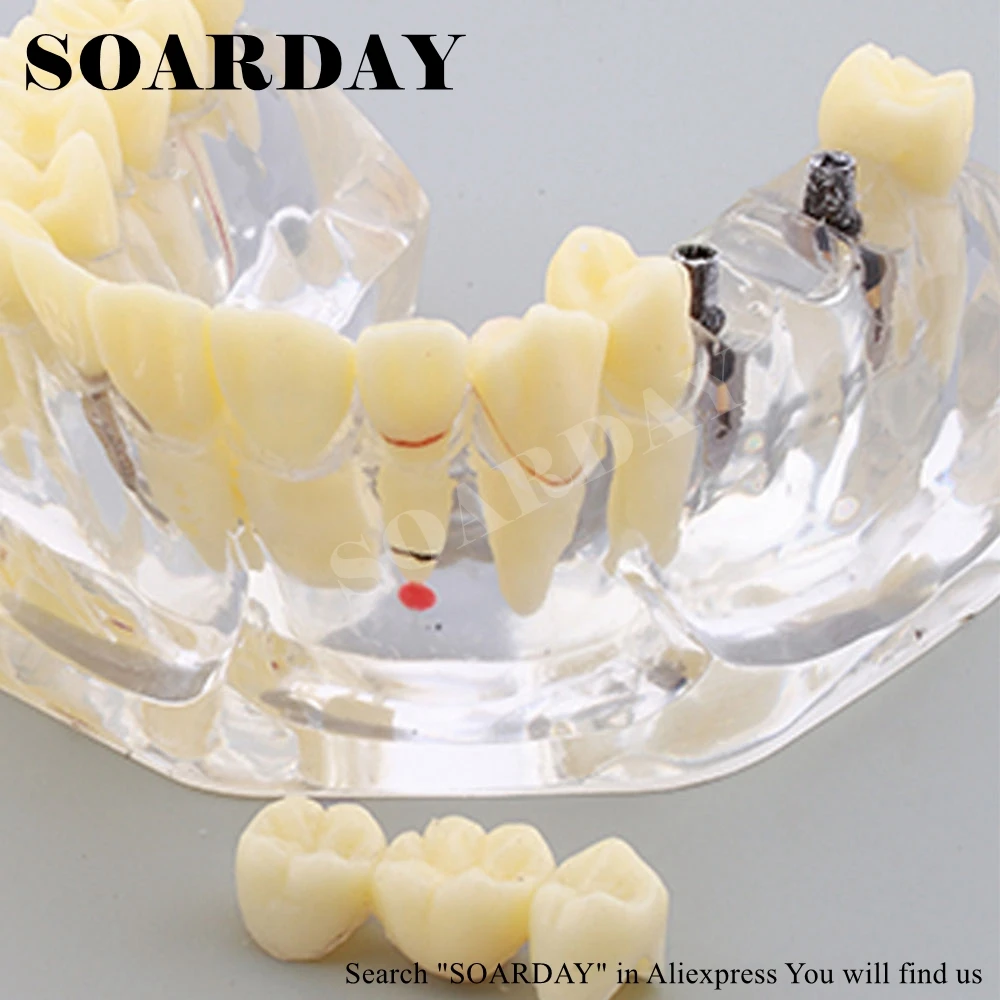 1 шт. стоматологическая патологическая модель импланта SOARDAY|bridge implant|implant modeldental