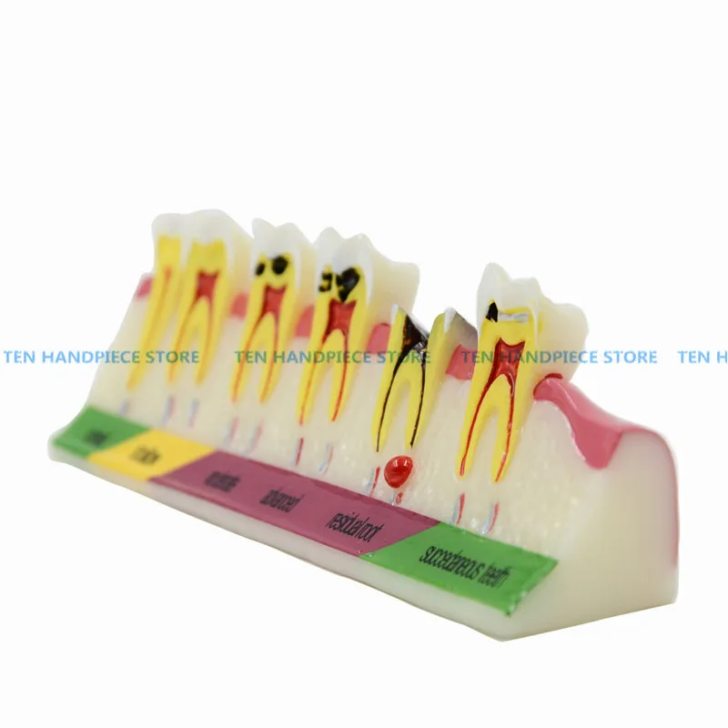 

2018 good quality Dental Caries Developing illusteation Tooth Model Demonstration Teach Patient