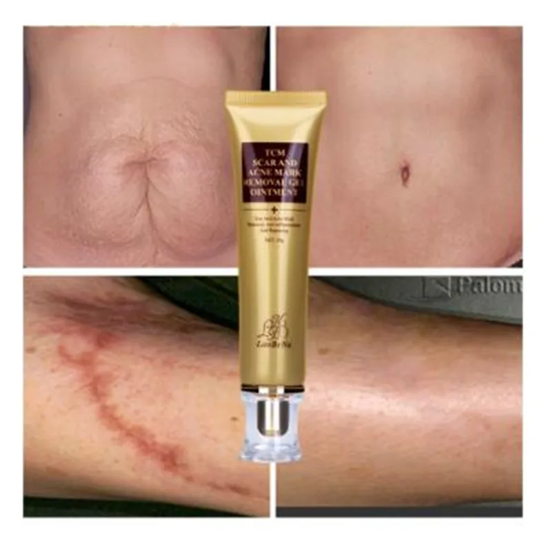 Крем для удаления акне LANBENA крем шрамов от пигментных пятен восстанавливает кожу