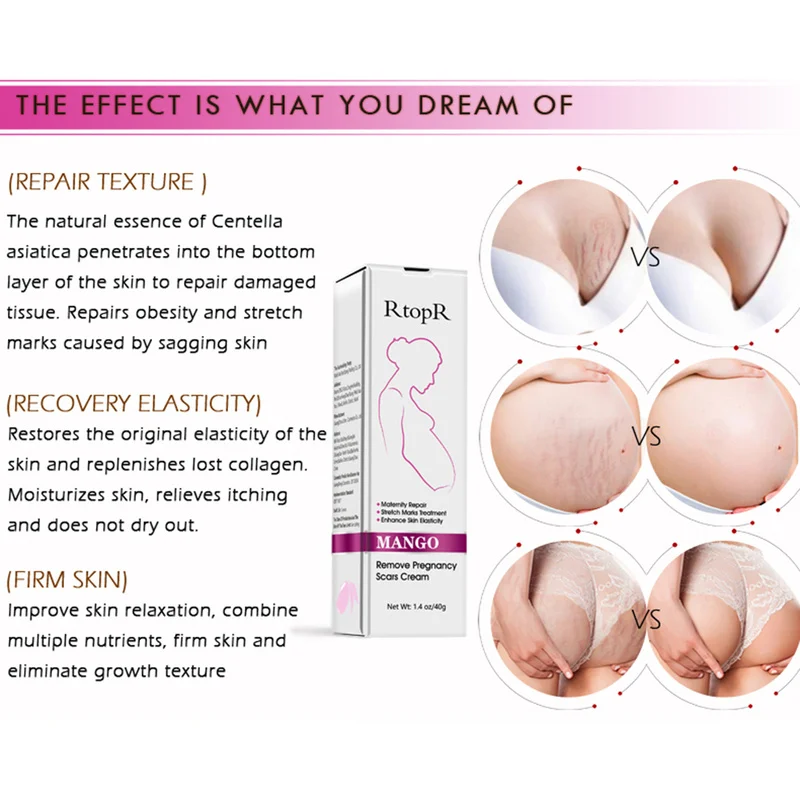 RtopR Natural Mild Non-irritating Mango Stretch Mark Cream Pregnancy Repair Scar Slack Line Abdomen Stretch Marks Cream TSLM1
