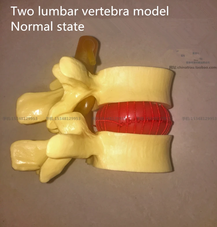 Медицинский Поясничный позвонка модель поражения нормальном состоянии CMAM VERTEBRA12
