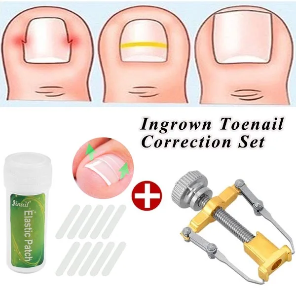 

1PC Stainless Steel Ingrown Toe Nail Correction Tool +10Pcs Nail Correction Patch Nails Art Equipment Tool