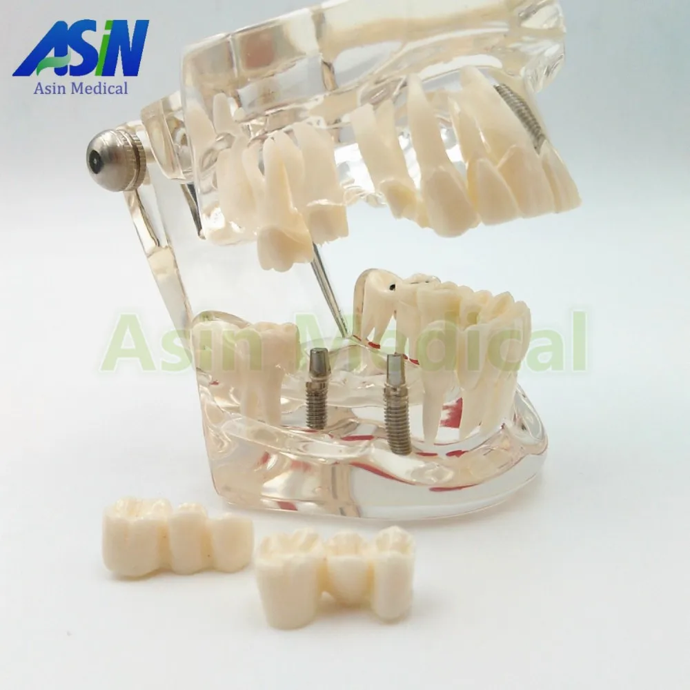 Демонстрационный кронштейн для имплантации зубов модель съемный | Красота и