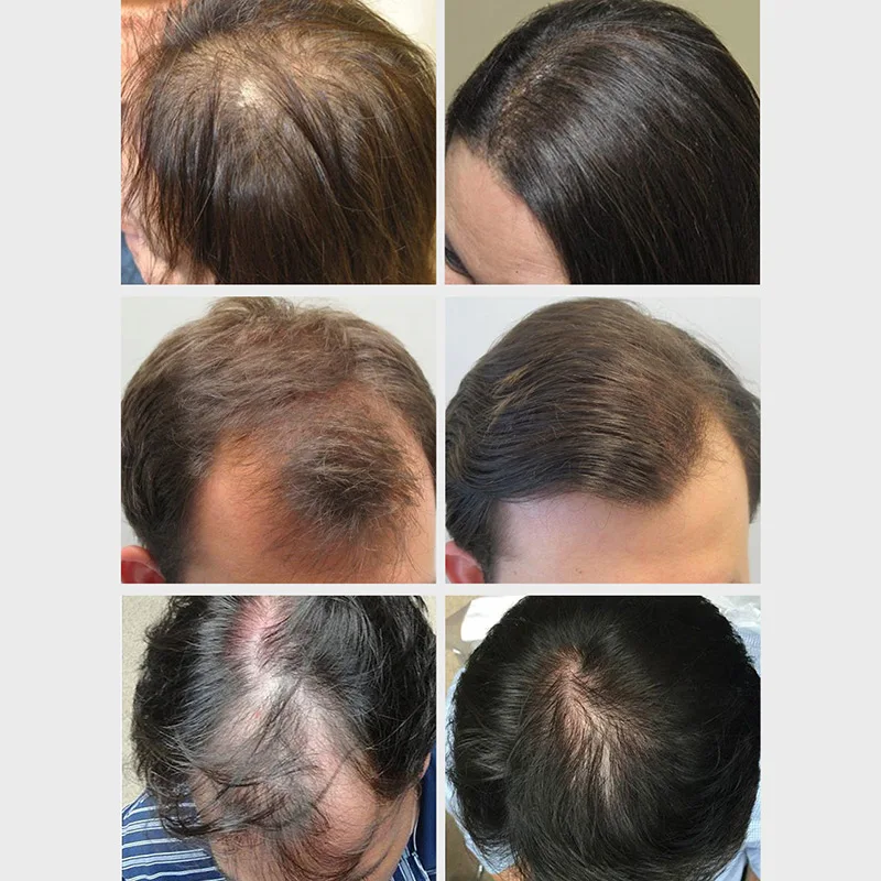 1 шт. Уход за волосами эссенция масло лечение роста против выпадения волос