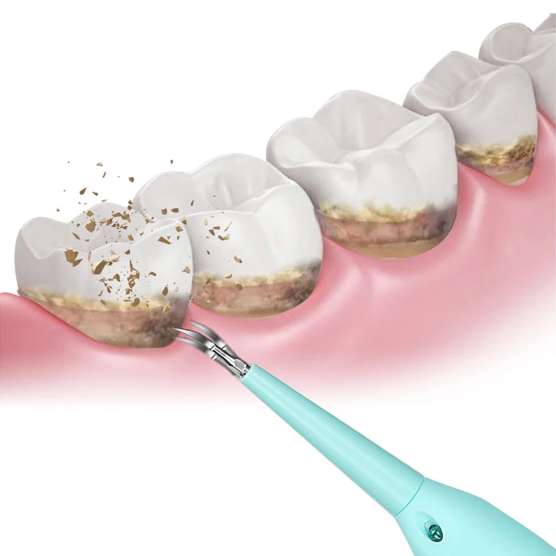 

Electric Tartar Remover Teeth Cleaning Tools Toothbrush Calculus Stains Scraper NShopping