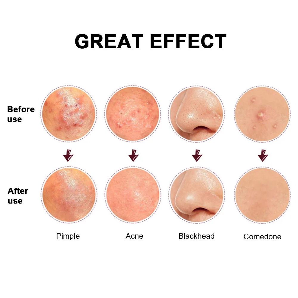 3 палочки для акне набор игл двойная головка сжимаемое кольцо изогнутый зажим рта