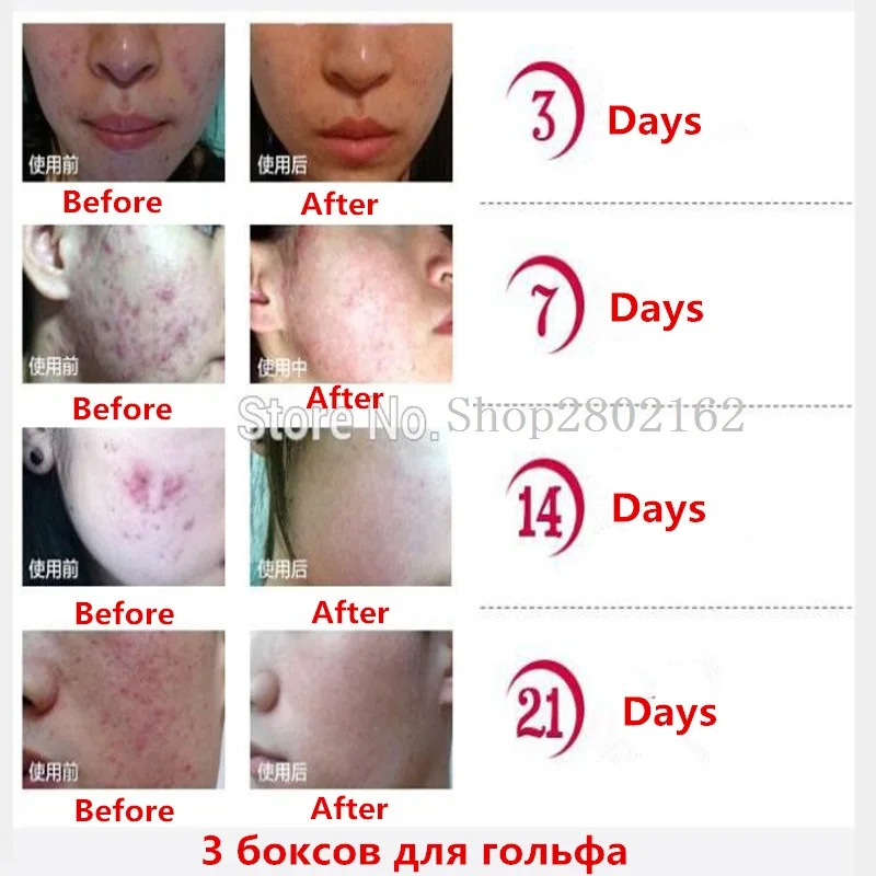 2018 высокое качество травяной очищающий гель Уход за лицом против акне лечение