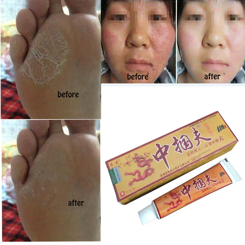 1 шт псориаз Eczema зуд псориаз проблемы с кожей Китай кремы псориаз кремы для очищения лица в розничной упаковке