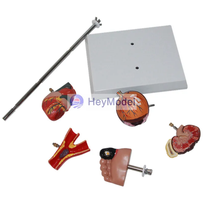 HeyModel человеческий диабет модель очага повреждений|Образовательное