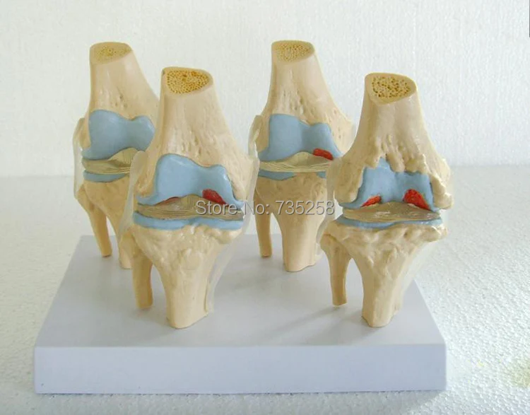 Human knee degenerative diseases presentation model,Knee joint model,Knee joint disease model