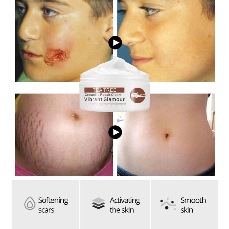 

Acne Scar Removal Cream Stretch Marks Skin Repair Face Cream Acne Spots Acne Treatment Whitening Cream Cosmetic