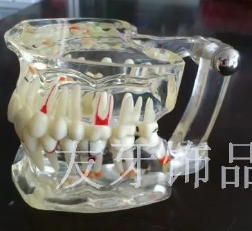 

free shipping transparent tooth model adult model tooth Pathological model