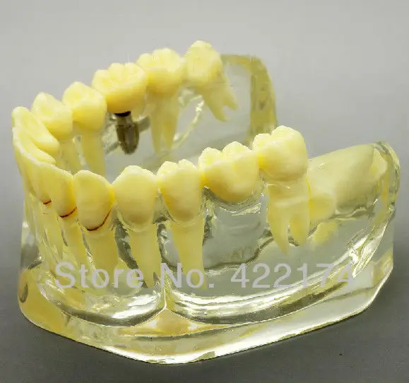 Бесплатная доставка протез для коррекции зубов модель исследования