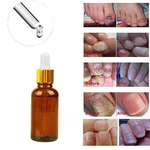 2016 Новый Палец ноги Ремонт Сущность Жидкость Грибок Ногтей Онихомикоз Удаления