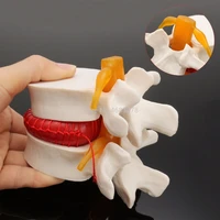 dental 11 human anatomy skeleton spine lumbar disc herniation teaching model