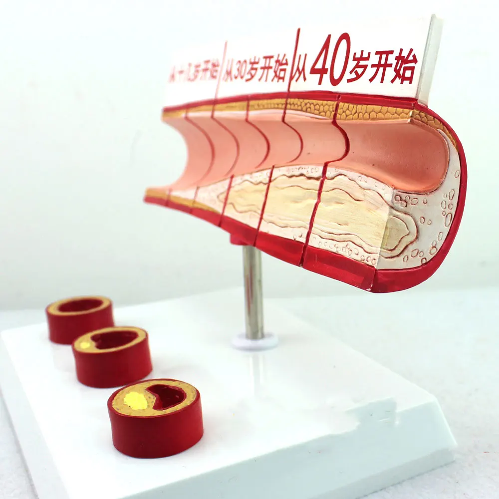 Подлинная модель кровяного холестерина и возраста EasyThru коронарная болезнь