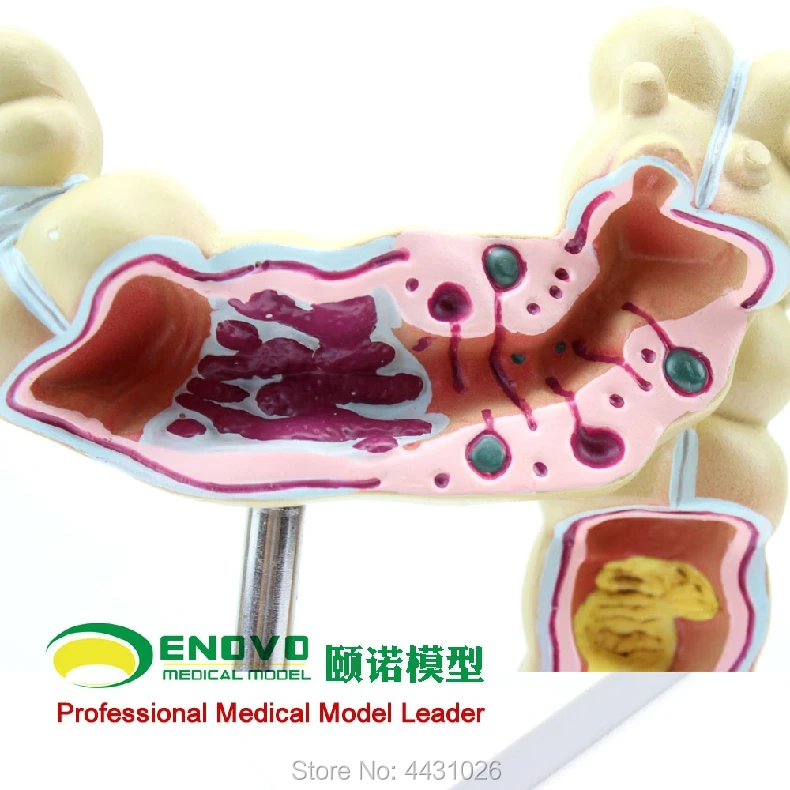 

ENOVO Human colon disease model human anatomy of large intestine model in gastroenterology department of anorectal department