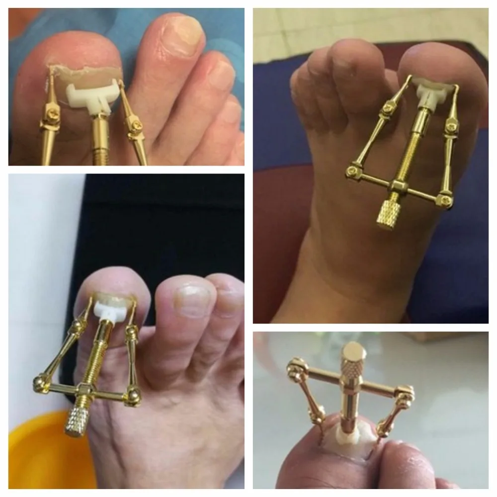 NEW PRO. Вросших ногтей ног коррекции инструмент фиксаж восстановить носок