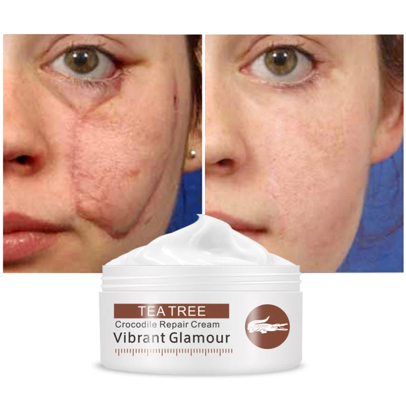 Крем для удаления черных точек растяжек и шрамов 30 г | Красота здоровье