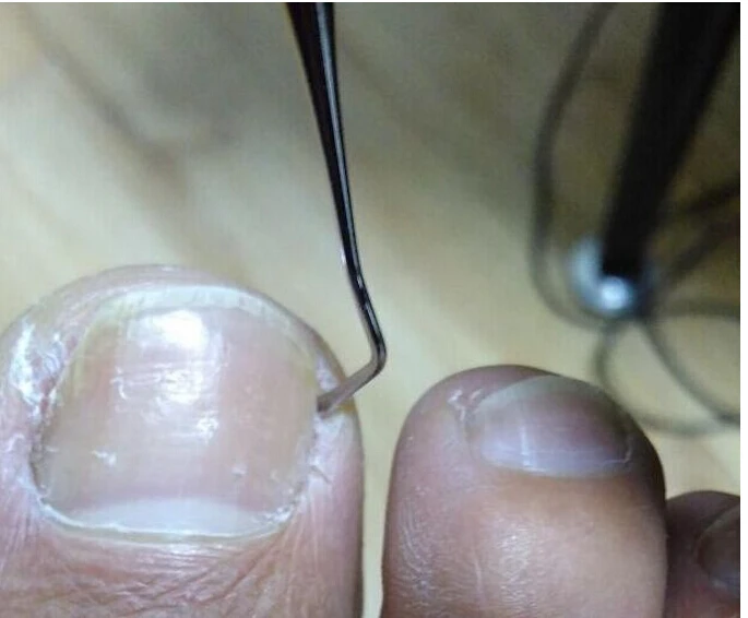 Профессиональный инструмент для коррекции вросших ногтей педикюрный Уход за