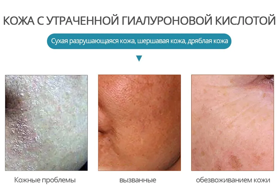 Яркая Гламурная Гиалуроновая кислота Сыворотка увлажняющая крем для лица с эфирными маслами сужает поры уход за кожей Ремонт Отбеливание антивозрастной
