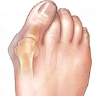 1 пара, ортопедический силиконовый разделитель для пальцев ног, при вальгусной деформации