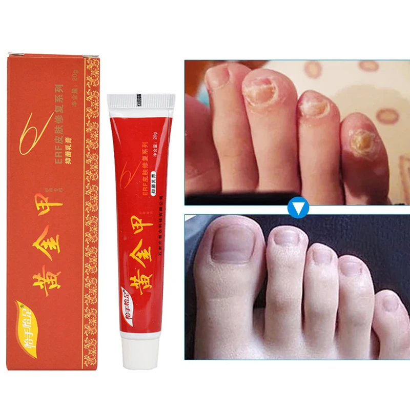 20 г Лечение грибка для лечения Ногтей мазь тоэнил онихомикоз борется с