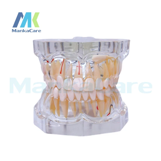 Manka Care - 2.5 Times Pathology Oral Model Teeth Tooth Model