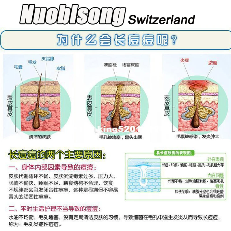 120 шт./лот специальный гель для лечения акне Nuobisong уход за лицом эффективно