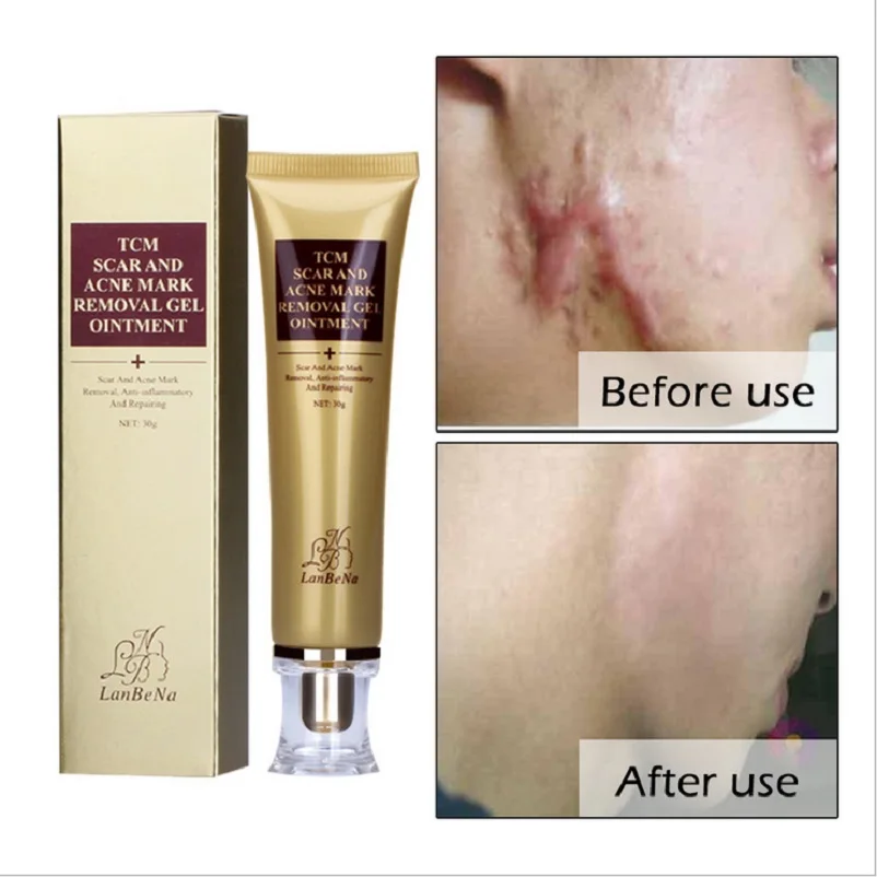 

5pcs/lot LANBENA Acne Scar Removal Cream Skin Repair Face Cream Acne Spots Acne Treatment Blackhead Whitening Stretch Marks 30ml