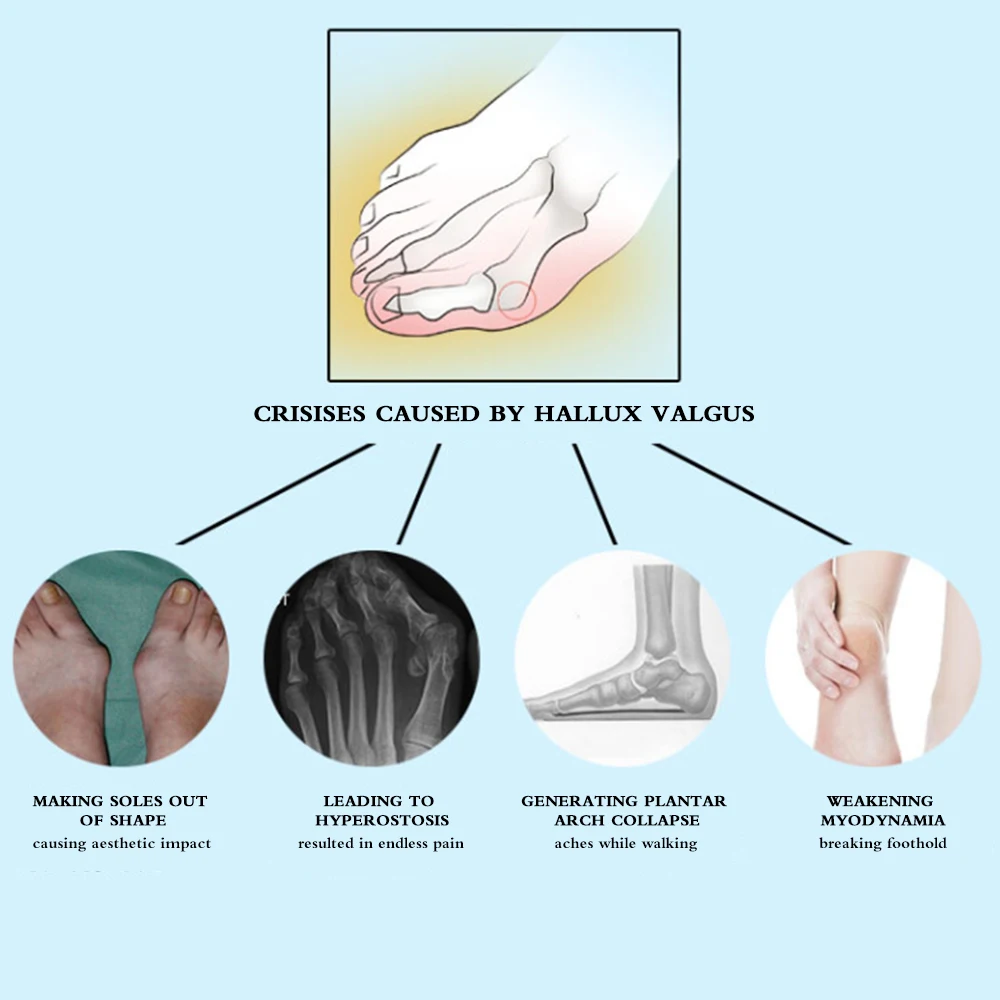 2 шт./пара вальгусная деформация первого пальца стопы боль пальцы ног два