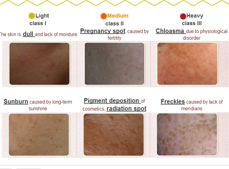 Красота уход за кожей Отбеливающий крем лицом средство для удаления темных пятен