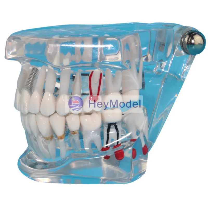 

HeyModel Transparent Teeth Repair Model Real Size 1:1