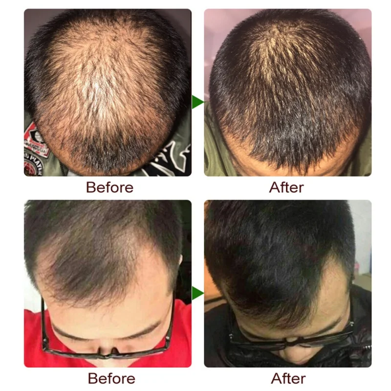 

Hair Care Hair Growth Essential Oils Essence Original Authentic 100% Hair Loss Liquid Hair Growth Serum
