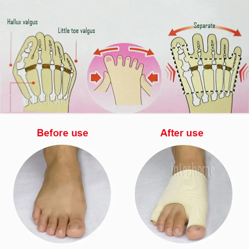 Разделяющие пальцы ортопедические рукава растягивающиеся при вальгусной