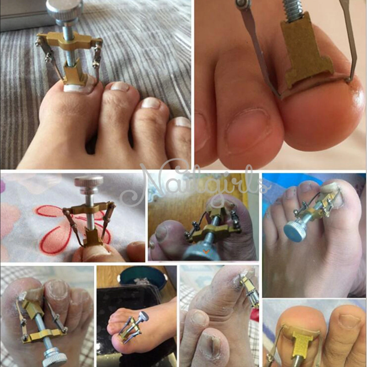 Silver Ingrown Toenails Care Tool Professional File Corrector Device Pedicure Foot Orthotic Acronyx Onyxis bunion Protector | Красота и